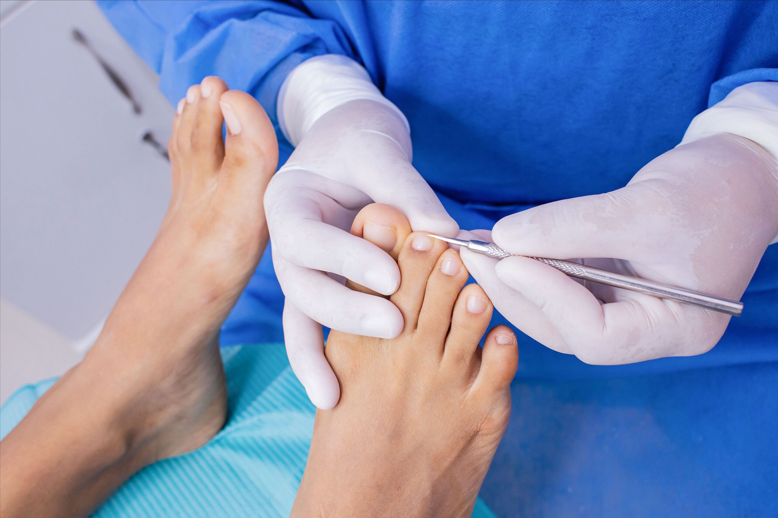 Limpieza de uñas (quiropodia)