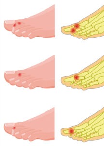 deformidades dedos de los pies